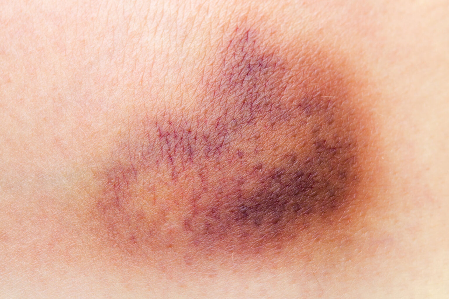 Bruises What They Are And How To Treat Dr Lauri Grossman
